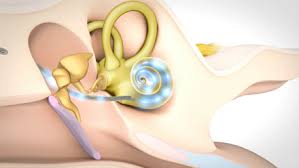 Implant Cochléaire Med El